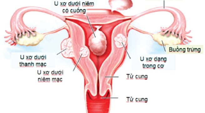 Các thủ pháp chữa bệnh u xơ tử cung