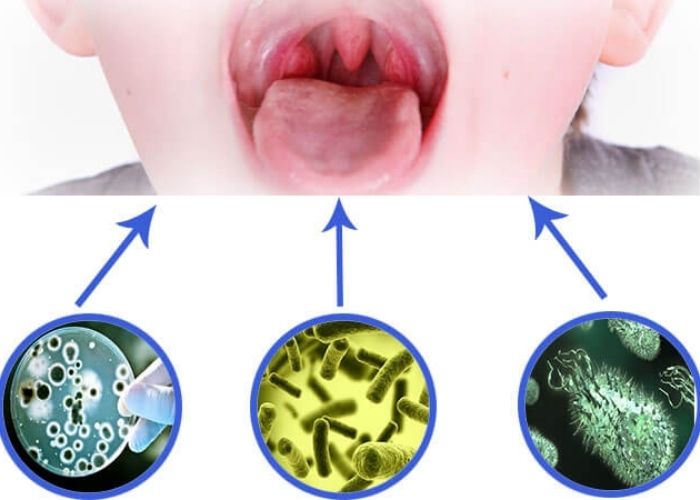 Sự tấn công của virus và vi khuẩn chính là nguyên nhân dẫn đến viêm họng thanh quản 