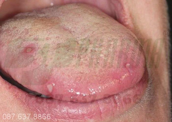 Nhiệt miệng là tình trạng trong khoang miệng xuất hiện các vết viêm loét 