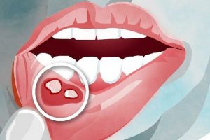 Mách bạn cách chữa nhiệt lưỡi hiệu quả với tủ thuốc "thảo dược"