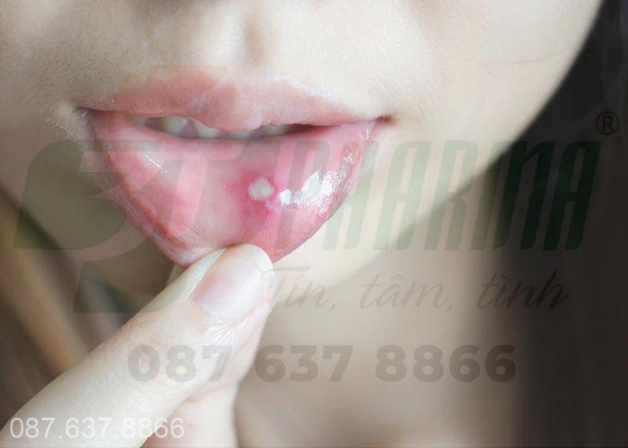 Nhiệt miệng là hiện tượng bị lở loét, nổi nốt trắng ở các vị trí trong khoang miệng 
