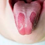 Nguyên nhân nhiệt lưỡi là gì? Hướng dẫn cách điều trị hiệu quả