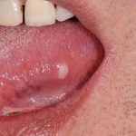 Nhiệt lưỡi là bệnh gì và cách điều trị hiệu quả nhanh chóng