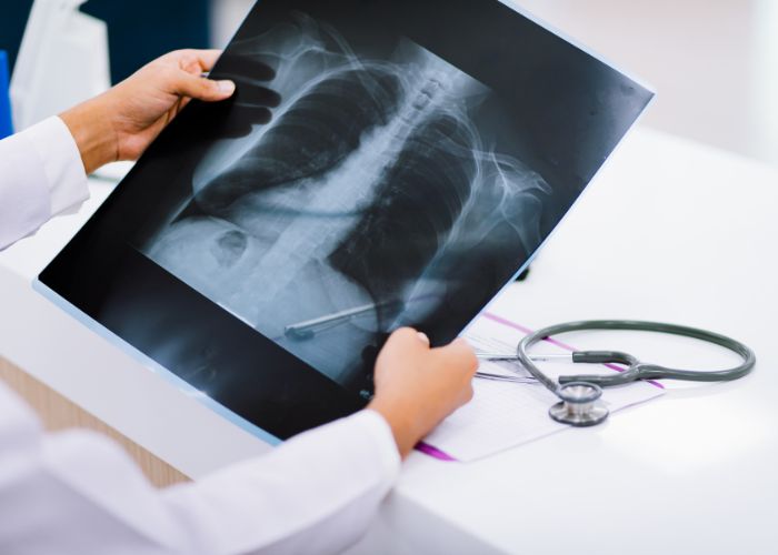 Chụp X-quang phổi giúp chẩn đoán chính xác viêm phế quản