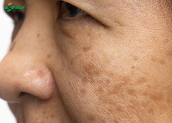 Da nhanh lão hóa, tăng sắc tố da cũng là triệu chứng dị ứng mỹ phẩm phổ biến