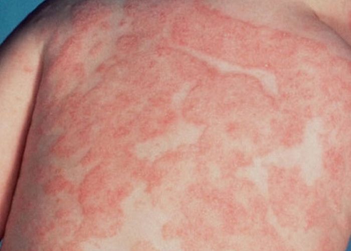 Bệnh lichen phẳng có thể ảnh hưởng đến nhiều vùng da khác nhau trên cơ thể