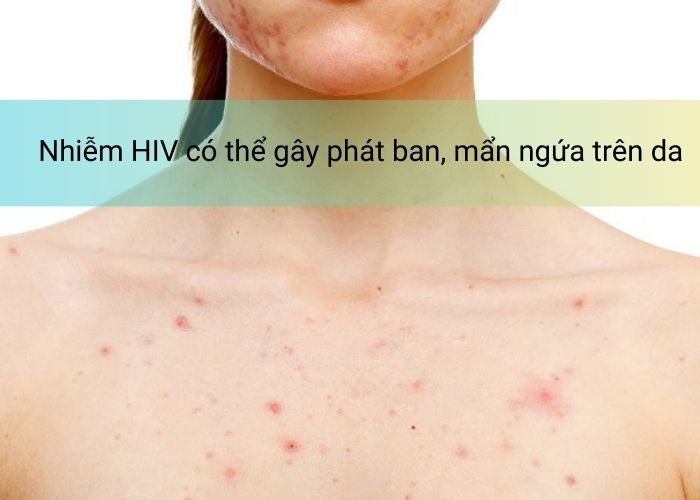 Nhiễm HIV có thể gây phát ban, mẩn ngứa trên da